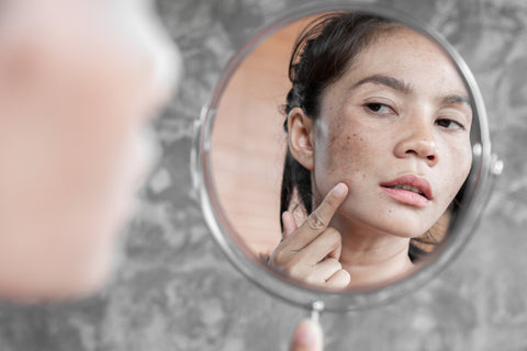 Melasma: o que é? Quais as causas e como identificar? - Terral Natural