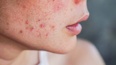 Descubra como tratar cicatrizes e manchas de acne de forma natural - Terral Natural